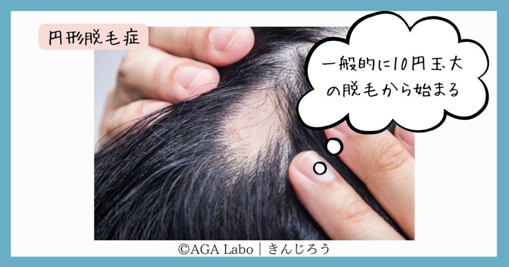 alopecia-areata